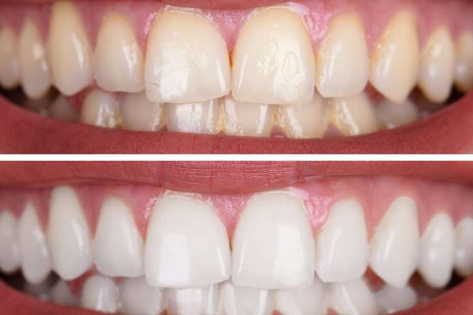 Teeth Whitening free mini course